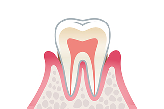 歯周炎（軽度）