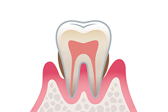 歯周炎（中度）