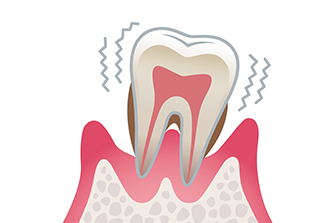 歯周炎（重度）